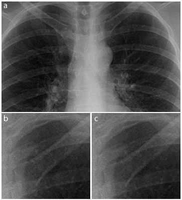 Original x-ray vs. GIF image.